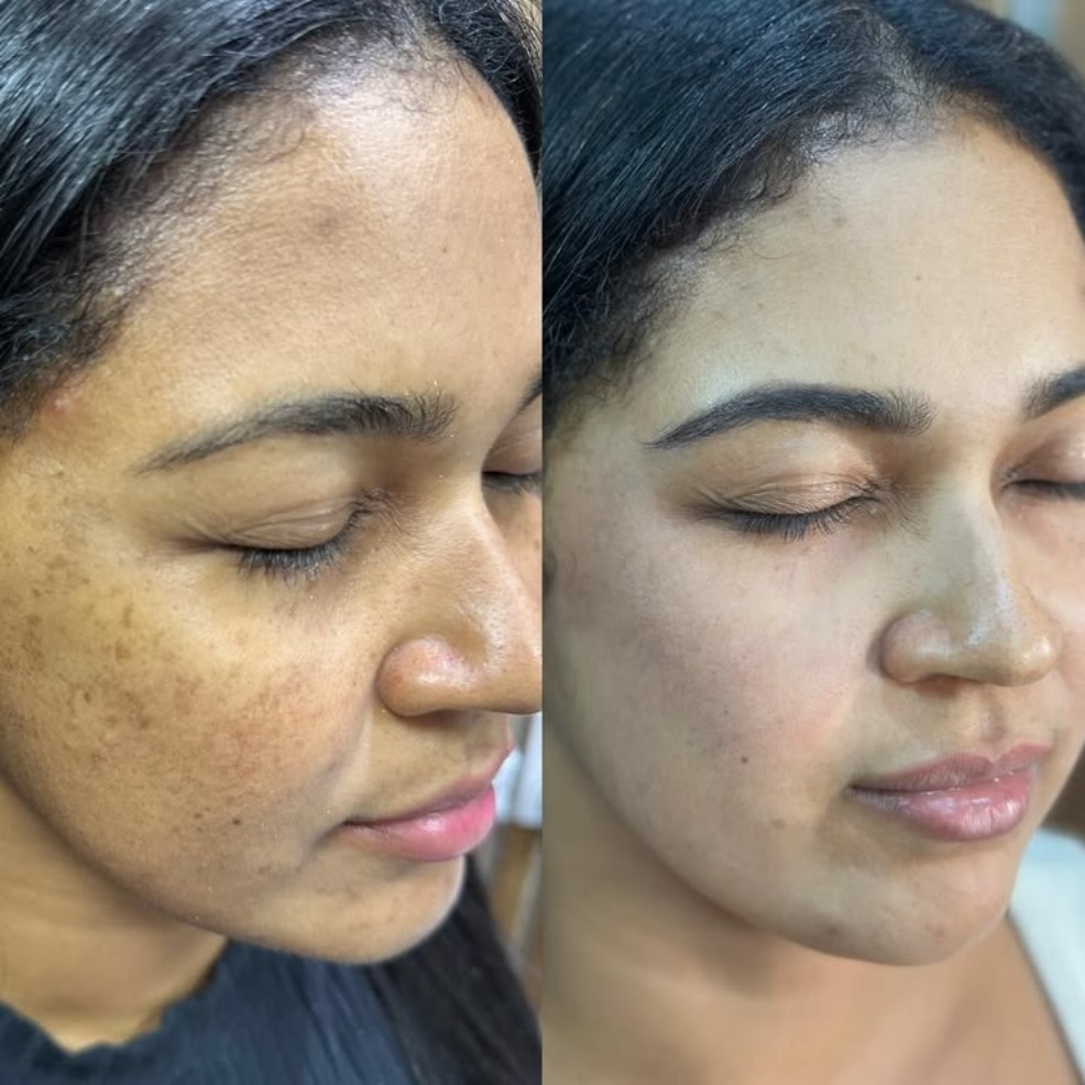 Before-and-after comparison showing visible improvement in uneven pigmentation and skin tone